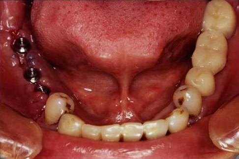 症例1 部分入れ歯をインプラントで治療したケース②