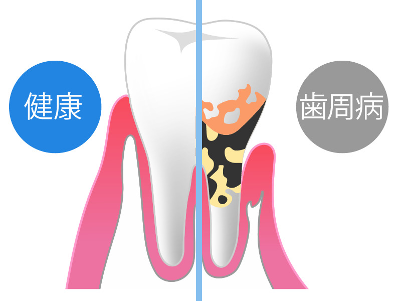 虫歯・歯周病を予防