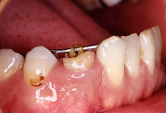 引っ張り上がった歯茎を元の位置に戻すために歯茎を下げる手術を行います。
