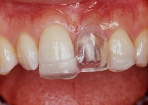 歯茎を下げる手術を行う前に、透明の歯のレプリカを作って、手術の指標にします。