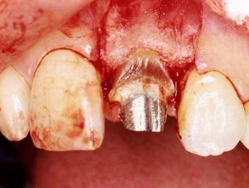 歯茎だけではなく、必要最小限の骨も整形して、他の歯とのバランスを取るように手術を行います。