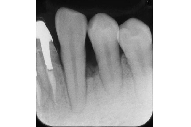 レントゲンで確認しますと、犬歯と第一小臼歯の間に深い骨の吸収が認められます。