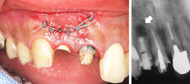 6.外科的歯内療法のイメージ④