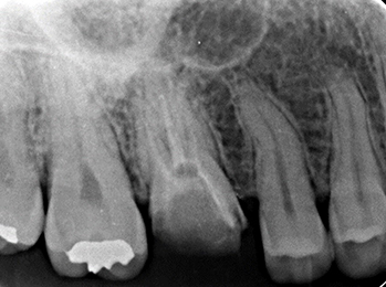 上顎第一大臼歯の近心根が2根ある症例①