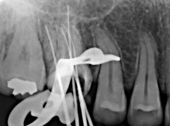 上顎第一大臼歯の近心根が2根ある症例③