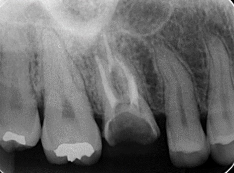 上顎第一大臼歯の近心根が2根ある症例④