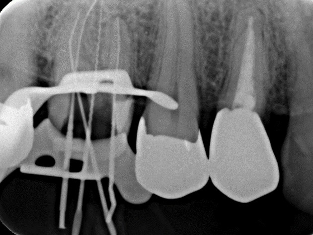 上顎第一大臼歯の口蓋根が2根ある症例②