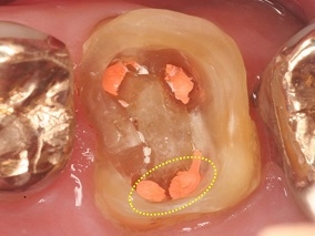 上顎第一大臼歯の口蓋根が2根ある症例③