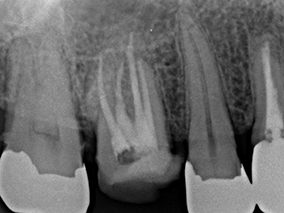 上顎第一大臼歯の口蓋根が2根ある症例④