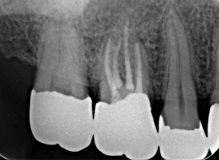 上顎第一大臼歯の口蓋根が2根ある症例⑤