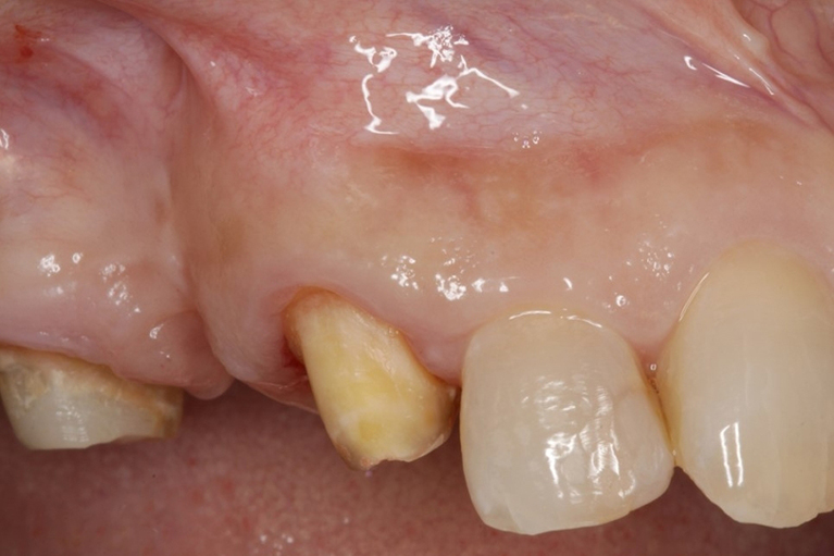 外科的歯内療法(歯根端切除術)で治療した症例④