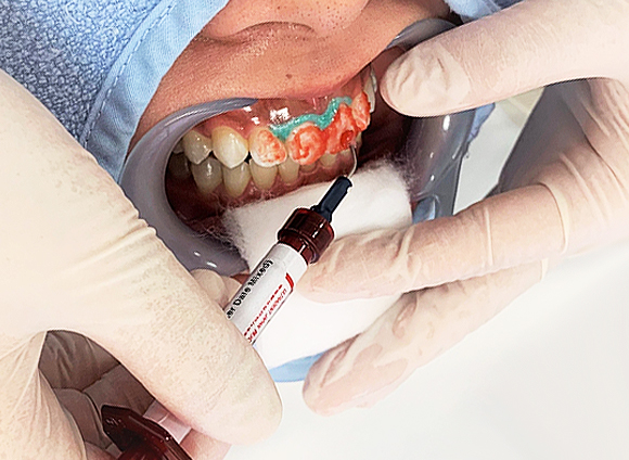 ホワイトニングの薬剤を歯に塗り、特殊な光を7分ほど当てます。 その後、薬剤を取り除きます。この工程を３回繰り返します。